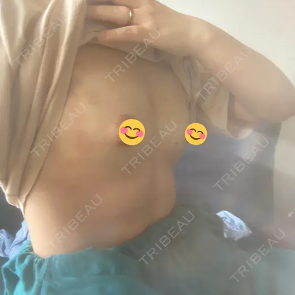 脂肪吸引（脚） / 豊胸（脂肪注入） 銀座マイアミ美容外科 DAY 1 メイン用