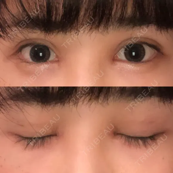 二重埋没 / 目頭切開 / 上まぶたの脂肪取り 湘南美容クリニック 柏院 AFTER メイン用