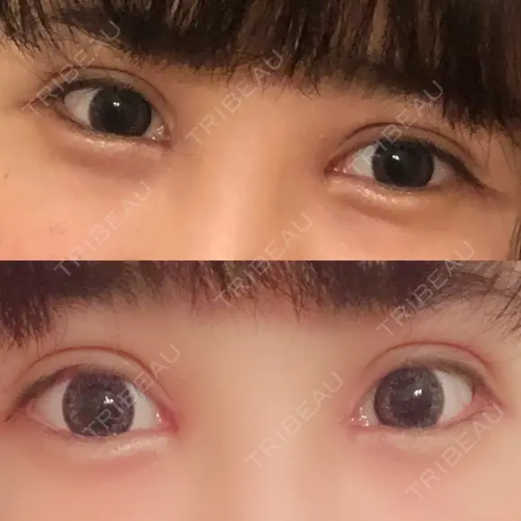 二重埋没 / 目頭切開 / 上まぶたの脂肪取り 湘南美容クリニック 柏院 DAY 27 メイン用
