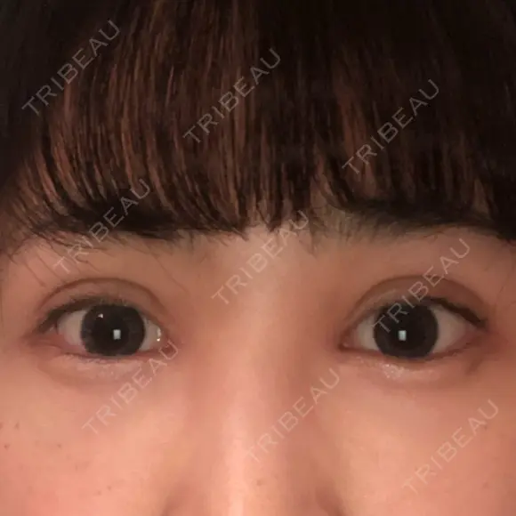 二重埋没 / 目頭切開 / 上まぶたの脂肪取り 湘南美容クリニック 柏院 DAY 19 メイン用