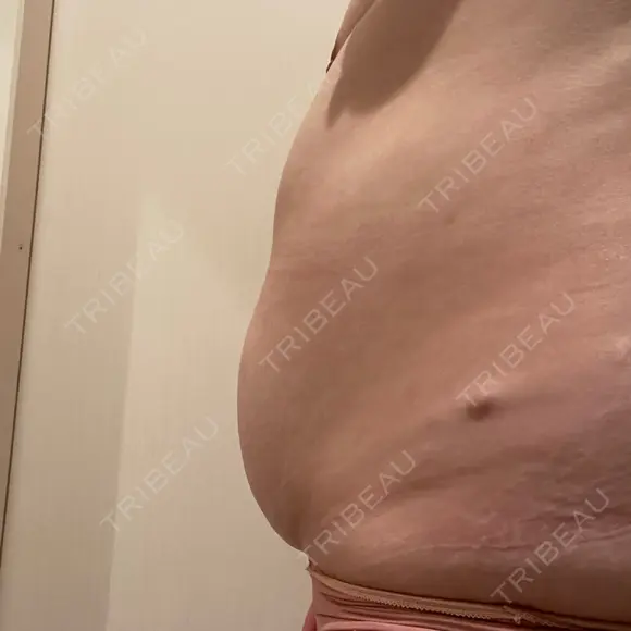 脂肪冷却（お腹） 品川スキンクリニック神戸院（※品川美容外科提携） DAY 1 メイン用