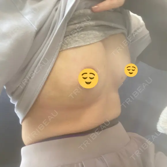 脂肪吸引（脚） / 豊胸（脂肪注入） 銀座マイアミ美容外科 DAY 2 メイン用