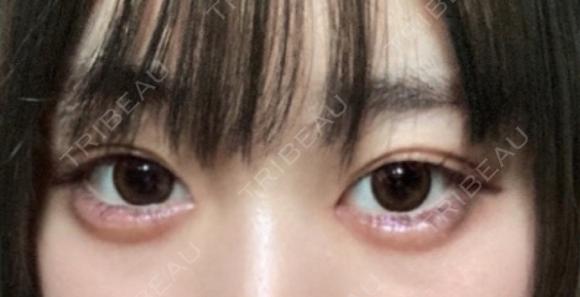 ヒアルロン酸注入（涙袋） フィラークリニック 名古屋栄院 DAY 4 メイン用