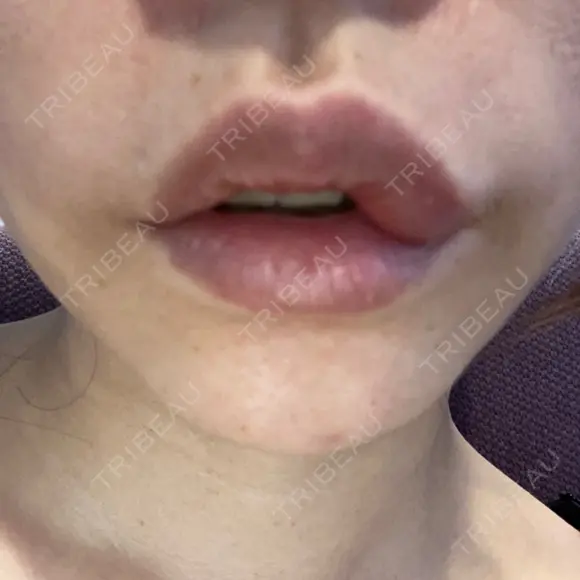 ヒアルロン酸注入（唇） / ボトックス（口角） / ボトックス（人中） ルラ美容クリニック 大宮院 / ルラスキンクリニック 大宮院 DAY 9 メイン用