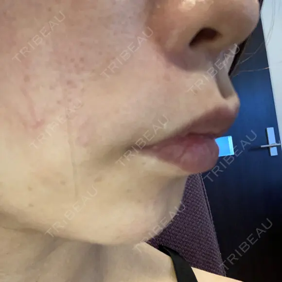 ヒアルロン酸注入（唇） / ボトックス（口角） / ボトックス（人中） ルラ美容クリニック 大宮院 / ルラスキンクリニック 大宮院 DAY 9 メイン用