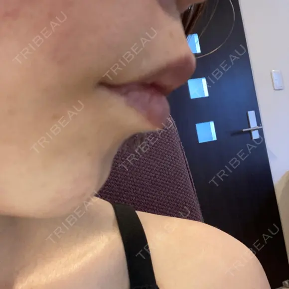 ヒアルロン酸注入（唇） / ボトックス（口角） / ボトックス（人中） ルラ美容クリニック 大宮院 / ルラスキンクリニック 大宮院 DAY 9 メイン用