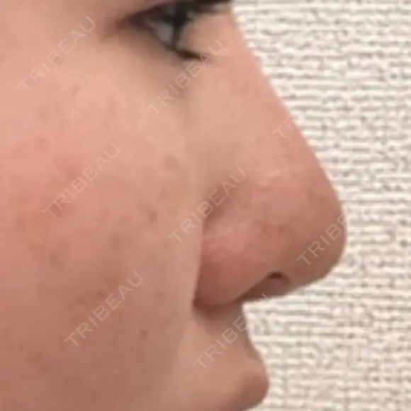 隆鼻術 / 鼻尖形成（切開） / 小鼻縮小（切開） / 軟骨移植 フェアクリニック川口 DAY 357 メイン用