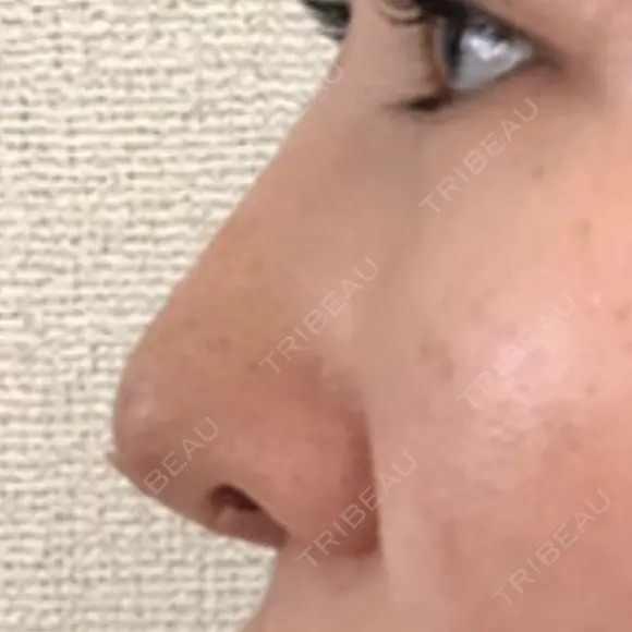 隆鼻術 / 鼻尖形成（切開） / 小鼻縮小（切開） / 軟骨移植 フェアクリニック川口 DAY 357 メイン用