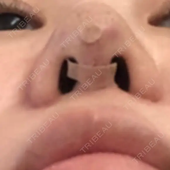 隆鼻術 / 鼻尖形成（切開） / 小鼻縮小（切開） / 軟骨移植 フェアクリニック川口 DAY 357 メイン用