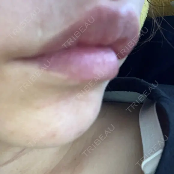 ヒアルロン酸注入（唇） / ボトックス（口角） / ボトックス（人中） ルラ美容クリニック 大宮院 / ルラスキンクリニック 大宮院 DAY 10 メイン用