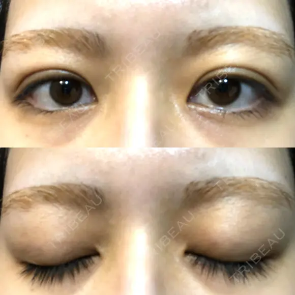 二重埋没 オアシス美容外科 DAY 9 メイン用
