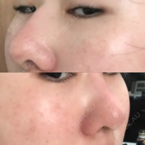 隆鼻術 / 鼻尖形成（切開） / 小鼻縮小（切開） / 軟骨移植 フェアクリニック川口 AFTER メイン用