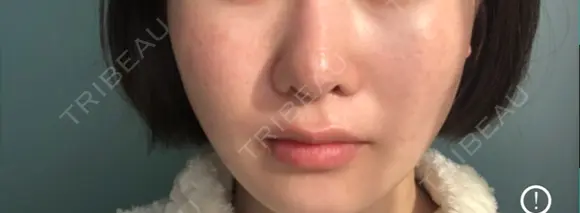 隆鼻術 / 鼻尖形成（切開） / 小鼻縮小（切開） / 軟骨移植 フェアクリニック川口 DAY 478 メイン用