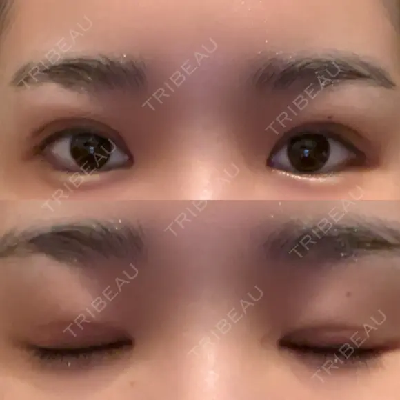 眼瞼下垂（切開） ステラ ロサ クリニック DAY 18 メイン用