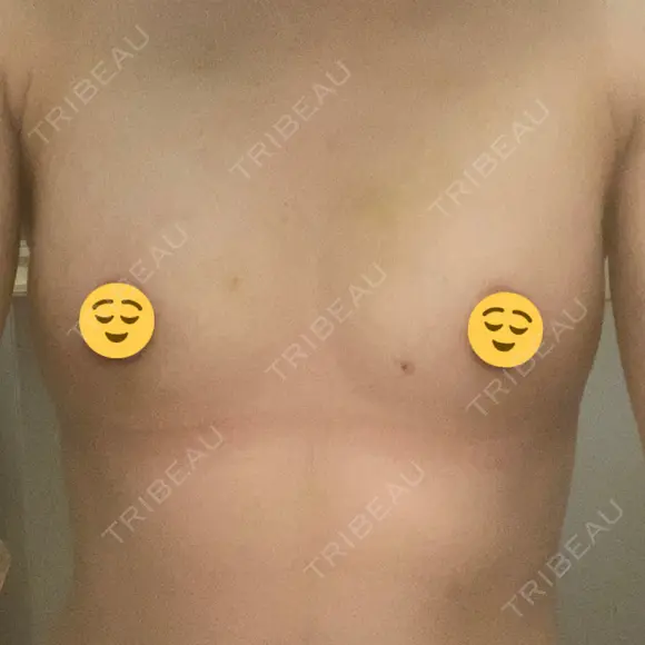 脂肪吸引（脚） / 豊胸（脂肪注入） 銀座マイアミ美容外科 AFTER メイン用