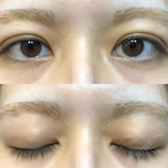 二重埋没 オアシス美容外科 DAY 13 メイン用