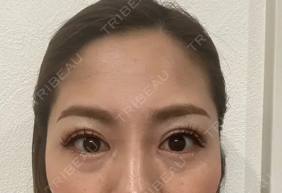 二重埋没 BIANCA表参道 DAY 15 メイン用