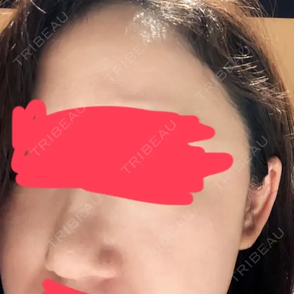 ヒアルロン酸注入（鼻） 東京美容外科 銀座院 DAY 0 メイン用