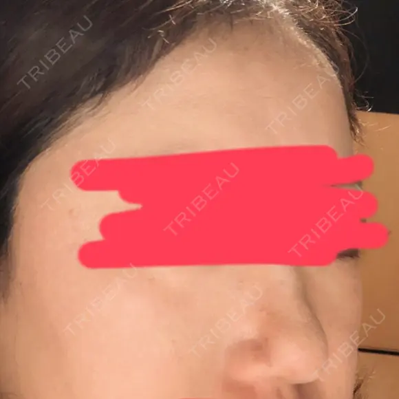 ヒアルロン酸注入（鼻） 東京美容外科 銀座院 DAY 0 メイン用