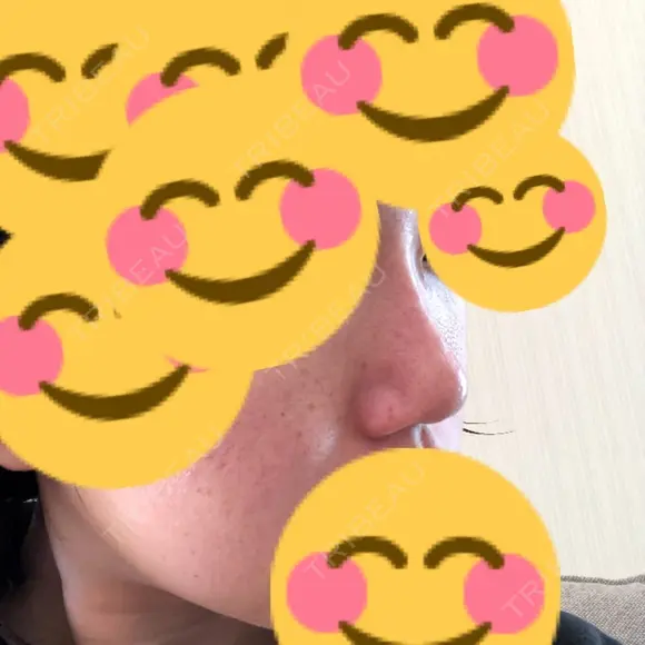 ヒアルロン酸注入（鼻） 東京美容外科 銀座院 DAY 10 メイン用