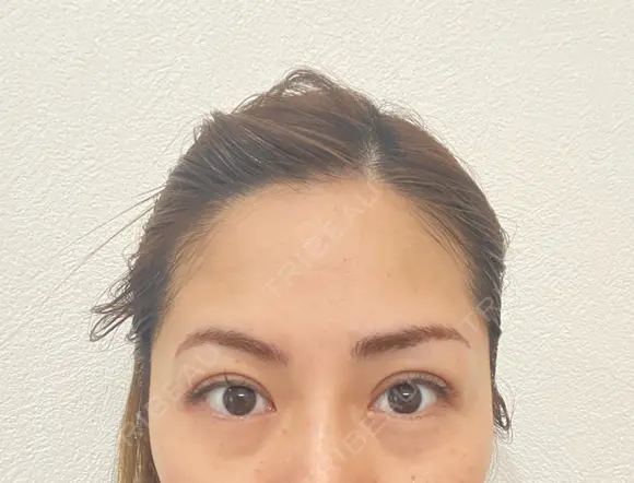 二重埋没 BIANCA表参道 DAY 16 メイン用