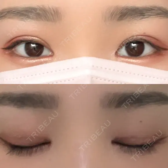 眼瞼下垂（切開） ステラ ロサ クリニック DAY 22 メイン用
