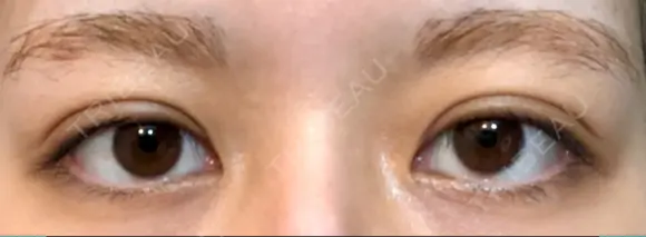 二重埋没 オアシス美容外科 DAY 16 メイン用