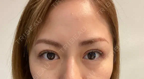 二重埋没 BIANCA表参道 DAY 17 メイン用