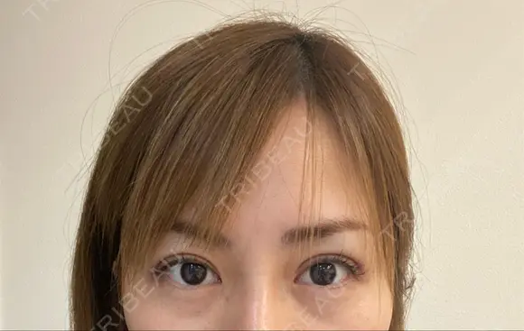 二重埋没 BIANCA表参道 AFTER メイン用