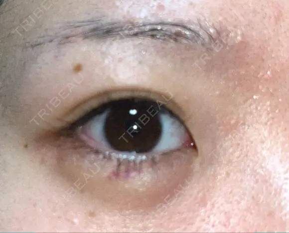 ヒアルロン酸注入（涙袋） 渋谷美容外科クリニック 新宿院 DAY 4 メイン用