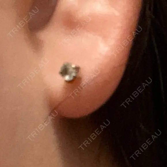 ピアス穴あけ 渋谷美容外科クリニック 渋谷院 DAY 3 メイン用