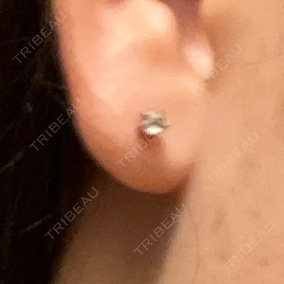 ピアス穴あけ 渋谷美容外科クリニック 渋谷院 DAY 3 メイン用