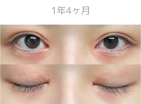 二重切開 / 目頭切開 / 上まぶたたるみ取り サラ美容外科 DAY 503 メイン用