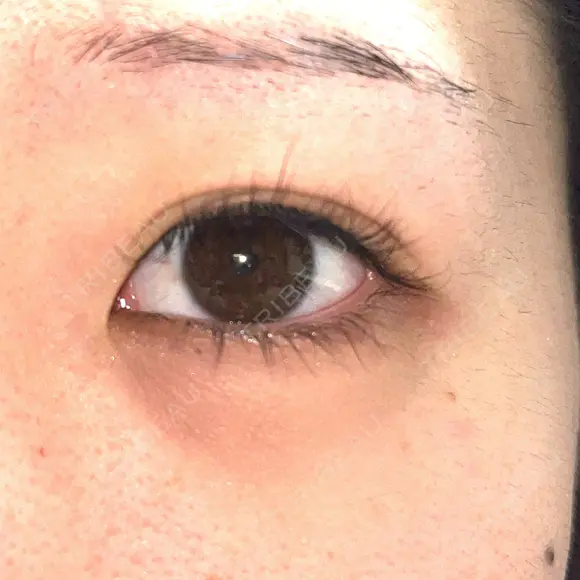ヒアルロン酸注入（涙袋） 渋谷美容外科クリニック 新宿院 DAY 6 メイン用
