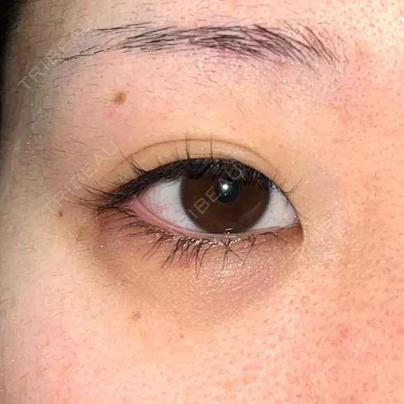 ヒアルロン酸注入（涙袋） 渋谷美容外科クリニック 新宿院 DAY 6 メイン用