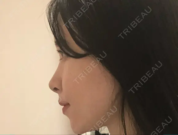 小鼻縮小（非切開） アリエル美容クリニック 大宮院 DAY 33 メイン用