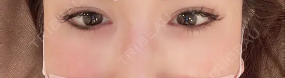 二重切開 / 眼瞼下垂（切開） / タレ目形成・グラマラスライン（切開） 湘南美容クリニック 辻堂アカデミア AFTER メイン用