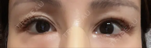 二重切開 / 眼瞼下垂（切開） / タレ目形成・グラマラスライン（切開） 湘南美容クリニック 辻堂アカデミア DAY 772 メイン用