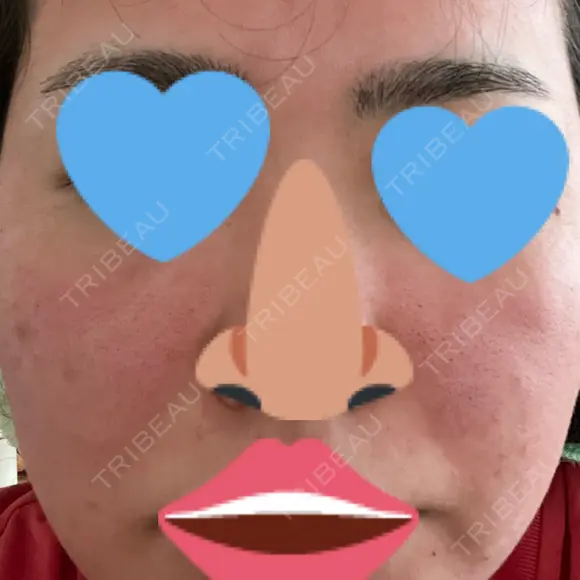 ヴェルヴェットスキン アリエル美容クリニック 大宮院 DAY 0 メイン用