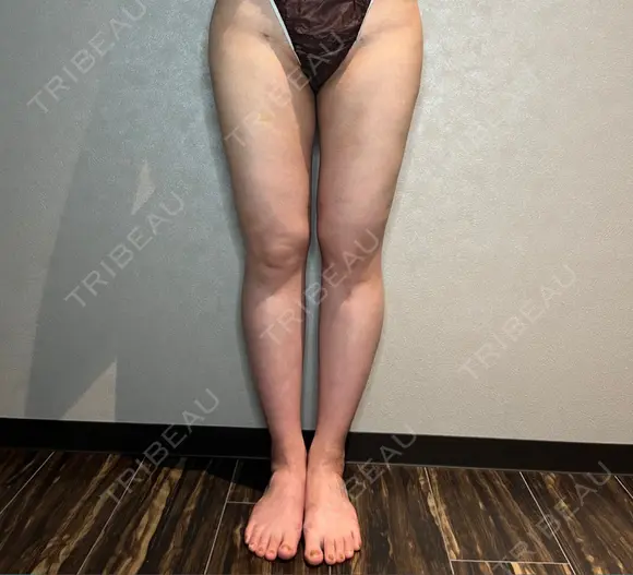 インディバ（腰） WOM SALON【術後ケア取扱いサロン】 DAY 18 メイン用
