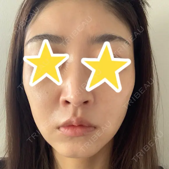 糸リフト 湘南美容クリニック 宇都宮院 AFTER メイン用