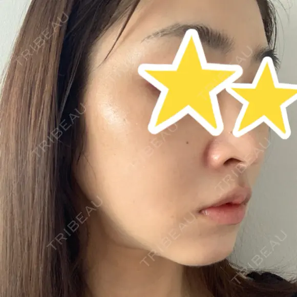 糸リフト 湘南美容クリニック 宇都宮院 DAY 58 メイン用