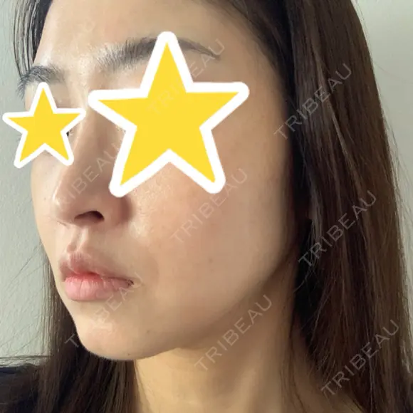 糸リフト 湘南美容クリニック 宇都宮院 DAY 58 メイン用