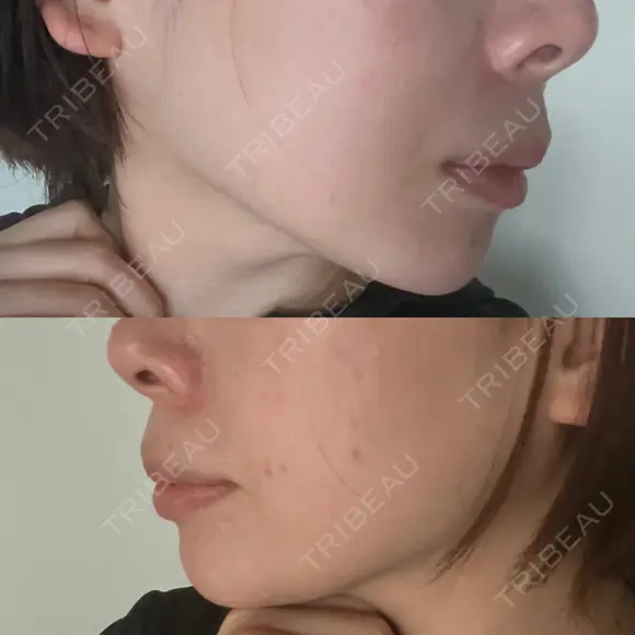 ヒアルロン酸注入（あご） 東京イセアクリニック AFTER メイン用