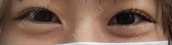 ヒアルロン酸注入（涙袋） Wクリニック 梅田院 AFTER メイン用