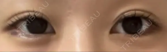 ヒアルロン酸注入（涙袋） Wクリニック 梅田院 DAY 2 メイン用