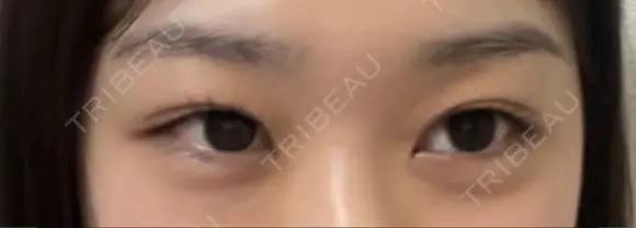 ヒアルロン酸注入（涙袋） Wクリニック 梅田院 AFTER メイン用