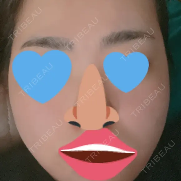 ヴェルヴェットスキン アリエル美容クリニック 大宮院 AFTER メイン用