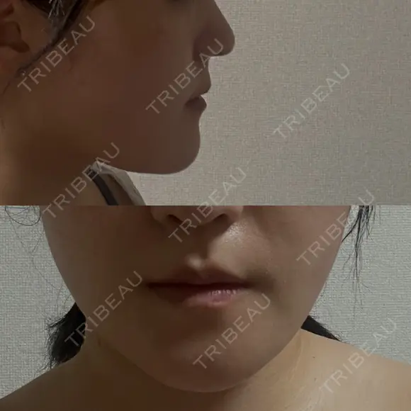 骨切り（あご） / 脂肪吸引（顔） / その他（輪郭） 銀座マイアミ美容外科 AFTER メイン用