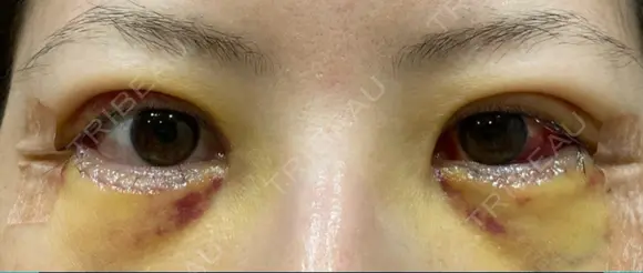 二重切開 / 目尻切開 / 上まぶたの脂肪取り / タレ目形成・グラマラスライン（切開） LIKI CLINIC KOBE DAY 4 メイン用